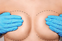 <i>Rippling</i> da mama: ondulações nas laterais das mamas <i>Rippling</i> da mama: ondulações nas laterais das mamas