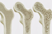 6 maneiras de proteger seus ossos contra a osteoporose e evitar fraturas 6 maneiras de proteger seus ossos contra a osteoporose e evitar fraturas