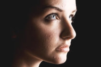 Acne na mulher adulta