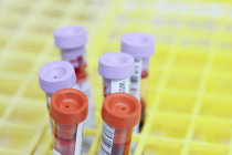 Anemia infantil - quais são as características e o que pode ser feito? Anemia infantil - quais são as características e o que pode ser feito?