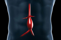 Aneurismas arteriais viscerais s&atilde;o raros, silenciosos e perigosos: saiba como identific&aacute;-los e trat&aacute;-los!