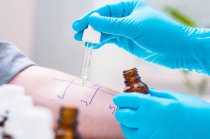 Angioedema cr&ocirc;nico al&eacute;rgico