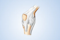 Artrodese: quando deve ser feita? Como o procedimento &eacute; realizado?