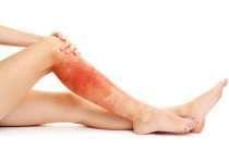 Celulite infecciosa - como ela é? O que deve ser feito para evitá-la? Celulite infecciosa - como ela é? O que deve ser feito para evitá-la?