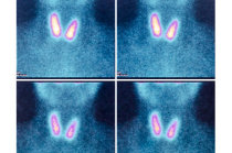 Cintilografia da tireoide