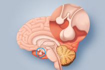 Cisto da Fenda de Rathke Cisto da Fenda de Rathke