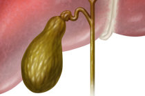 Colecistite: o que &eacute;? Quais as causas? E os sintomas? Como s&atilde;o o diagn&oacute;stico e o tratamento? Como evitar? Quais s&atilde;o as complica&ccedil;&otilde;es poss&iacute;veis?