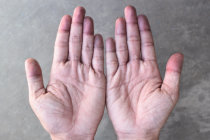 Como &eacute; a acrocianose?