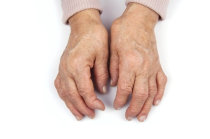 Como &eacute; a osteoartrite?