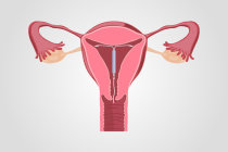 DIU Mirena - informações para conhecê-lo DIU Mirena - informações para conhecê-lo