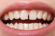 Dentes separados - voc&ecirc; pode ter diastema!