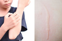 Dermografismo - marcas vermelhas salientes, parece que escreveram na minha pele