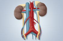 Displasia renal