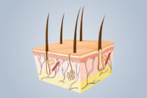 Doença de Bowen Doença de Bowen