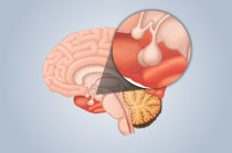 Doença de Cushing é diferente de Síndrome de Cushing Doença de Cushing é diferente de Síndrome de Cushing