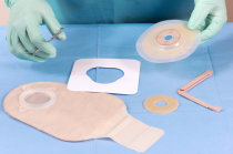 Enterostomia - como &eacute; o procedimento? Quando deve ser feito? Como &eacute; a evolu&ccedil;&atilde;o?