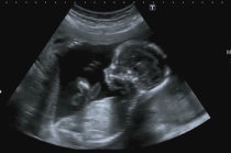 Espinha bífida - defeito do tubo neural que pode ser evitado com o uso de ácido fólico na gravidez Espinha bífida - defeito do tubo neural que pode ser evitado com o uso de ácido fólico na gravidez