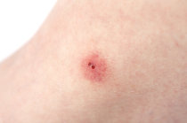 Fur&uacute;nculo: como &eacute;? Precisa tratar? Como evitar?