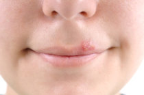 Herpes Simples. O que &eacute;?
