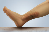 Insufici&ecirc;ncia venosa cr&ocirc;nica - como reconhec&ecirc;-la?