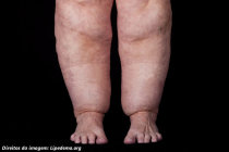 Lipedema - características, diagnóstico e o que fazer Lipedema - características, diagnóstico e o que fazer