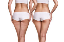 Lipodistrofias ginoides - o nome científico da celulite! Lipodistrofias ginoides - o nome científico da celulite!