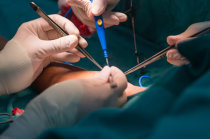 O que s&atilde;o f&iacute;stulas?