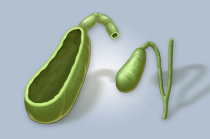 Pólipos da vesícula biliar Pólipos da vesícula biliar