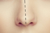 Rinoplastia ou pl&aacute;stica no nariz: o que &eacute;? Quando fazer? Como &eacute;? O que fazer no p&oacute;s-operat&oacute;rio?