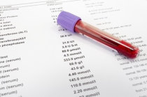 S&iacute;ndrome antifosfol&iacute;pide - Sintomas, diagn&oacute;stico, tratamento e evolu&ccedil;&atilde;o