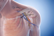 Síndrome do desfiladeiro torácico Síndrome do desfiladeiro torácico