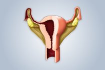 Sinéquias uterinas: o que é isso? Sinéquias uterinas: o que é isso?