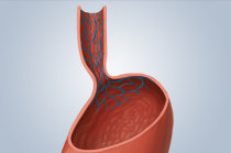Varizes esof&aacute;gicas: o que s&atilde;o? Quais as causas? Como s&atilde;o o diagn&oacute;stico e o tratamento? Como evoluem? Tem jeito de evitar?
