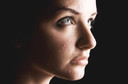 Acne na mulher adulta