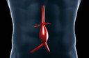 Aneurismas arteriais viscerais são raros, silenciosos e perigosos: saiba como identificá-los e tratá-los!