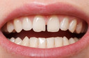 Dentes separados - voc&ecirc; pode ter diastema!
