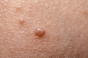 Molusco contagioso - conheça essa infecção de pele