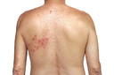 Neuralgia p&oacute;s-herp&eacute;tica: por que a dor do herpes-z&oacute;ster pode persistir por meses ou anos?