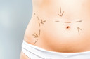 Pl&aacute;stica de barriga ou abdominoplastia - quando fazer e quando n&atilde;o fazer?