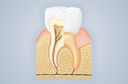 Tratamento de canal dent&aacute;rio